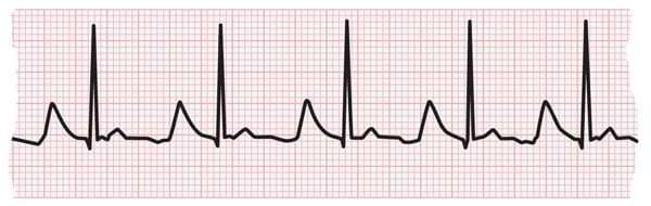 心电图条显示心跳正常